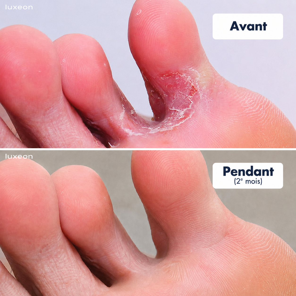 Stylo de traitement pour les pieds