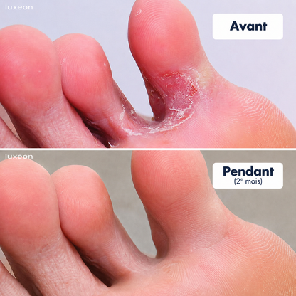 Stylo de traitement pour les pieds