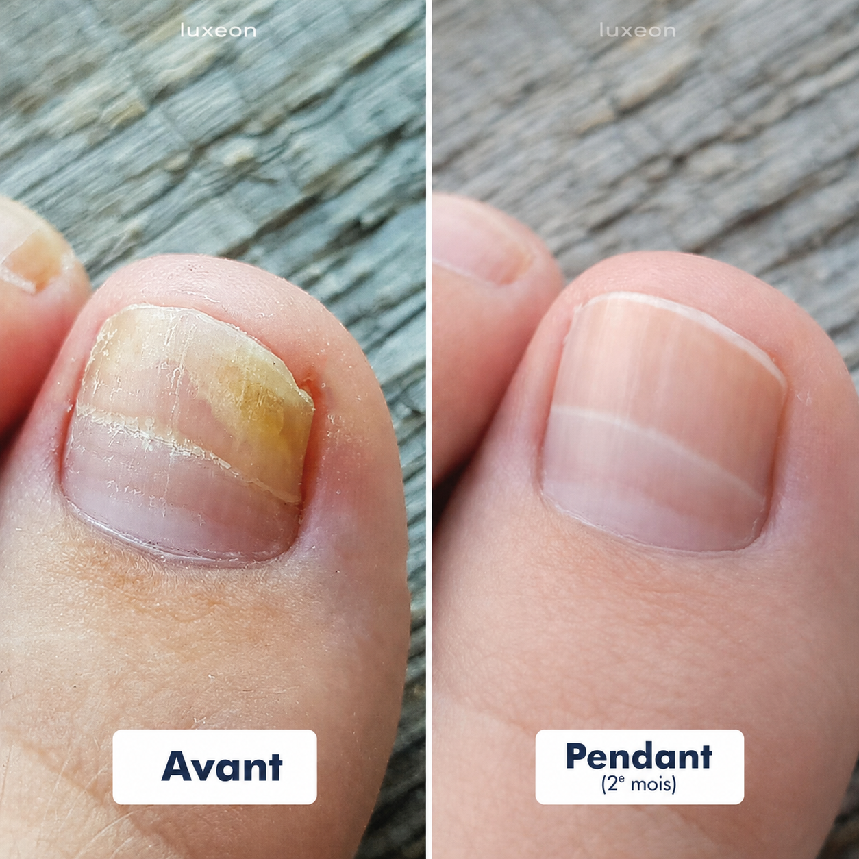 Stylo de traitement pour les pieds